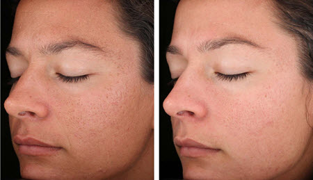 Fotos antes y después del rejuvenecimiento facial con láser