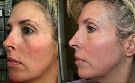 Fotos antes y después del rejuvenecimiento facial con láser